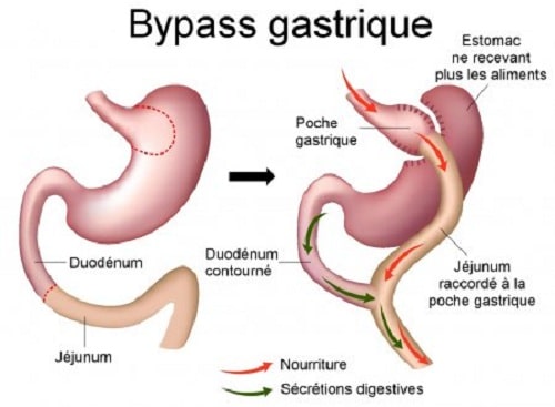 bypass tunisie